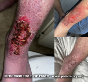HOME 13 nasty-ankle-posion-ivy-rash