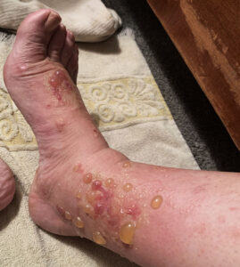 poison-ivy-foot-rash