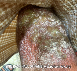 poison-ivy-knee-nightmare
